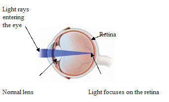 cataract1