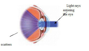 cataract2