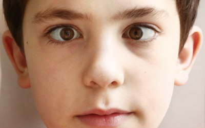 strabismus-Adobe-stock (1)